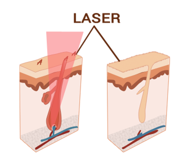 diode-laser-depil-beauty